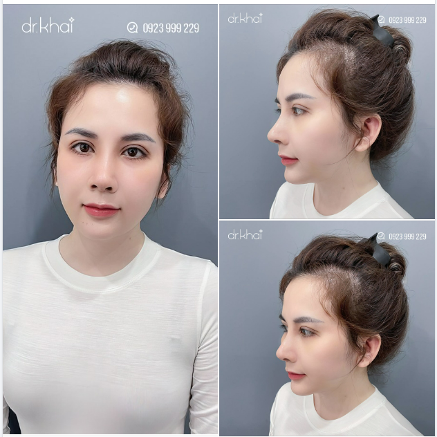Chị khách làm dịch vụ nâng mũi cấu trúc, chỉnh xương, chỉnh hở lỗ mũi và quay lại tái khám sau 6 tháng.