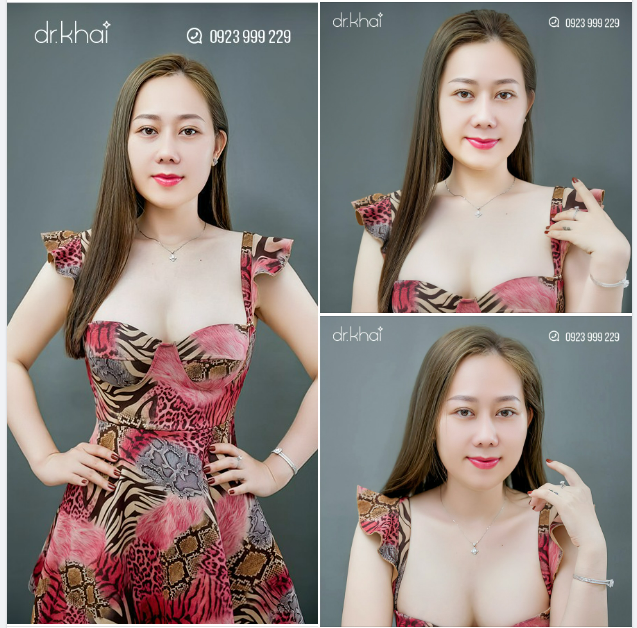 THAY ĐỔI TOÀN DIỆN SAU 4 THÁNG NÂNG MŨI, NÂNG NGỰC