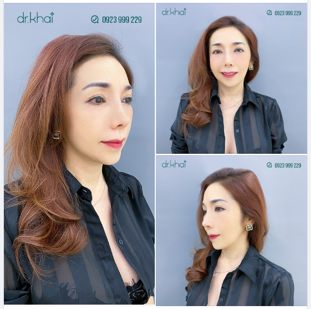 MŨI ĐẸP SAU 1 THÁNG