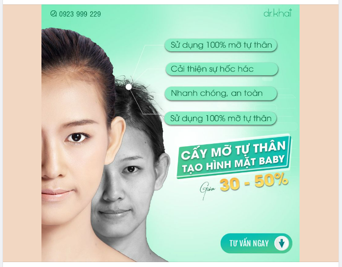 CẤY MỠ TỰ THÂN - TẠO HÌNH MẶT BABY