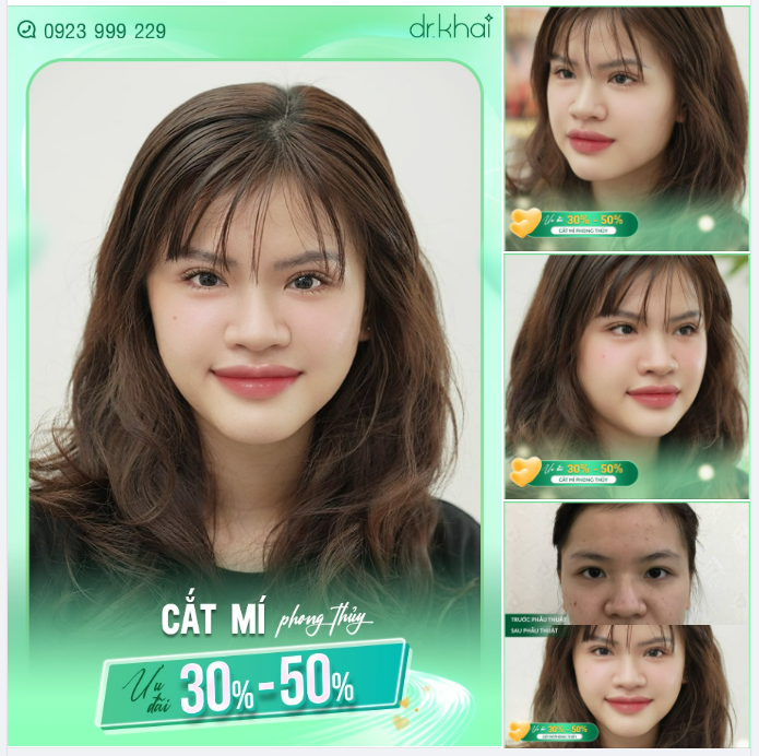 CẬN CẢNH NẾP MÍ THÁI TỰ NHIÊN CỦA KHÁCH HÀNG SAU 3 TUẦN PHẪU THUẬT.