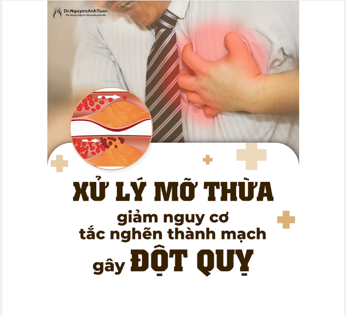 Xử lý MỠ THỪA giảm nguy cơ tắc nghẽn thành mạch gây ĐỘT QUỴ cao