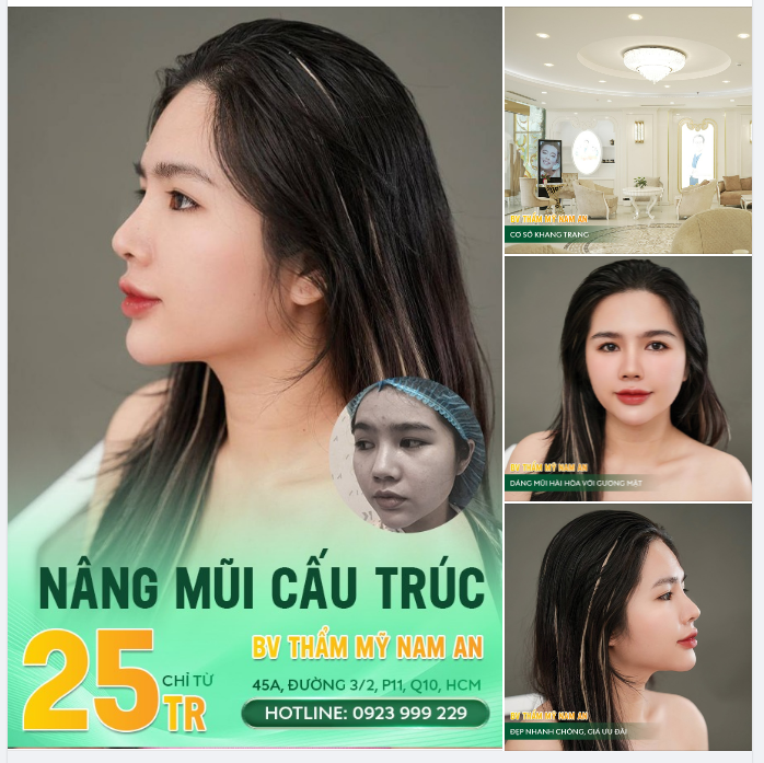NÂNG MŨI CẤU TRÚC CHUẨN BỆNH VIỆN CHỈ VỚI 25 TRIỆU!!