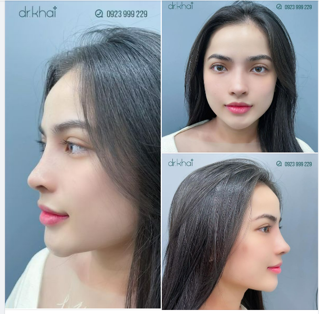 NÂNG MŨI CẤU TRÚC 1 TUẦN ĐẸP TỰ NHIÊN