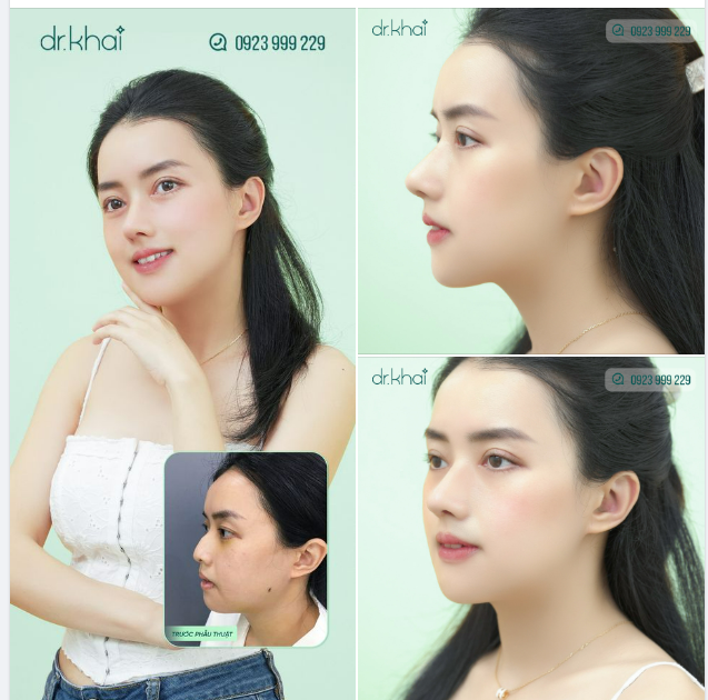 MÍ - MŨI ĐẸP TỰ NHIÊN SAU 11 NGÀY
