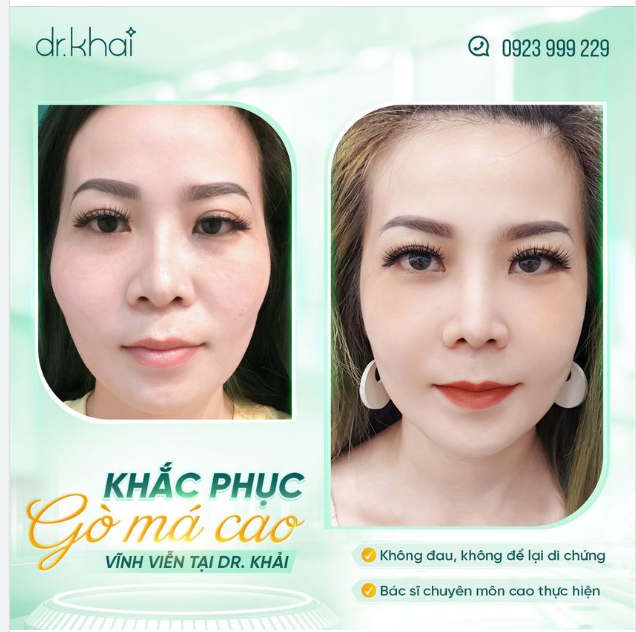 KHẮC PHỤC GÒ MÁ CAO VĨNH VIỄN TẠI DR KHẢI