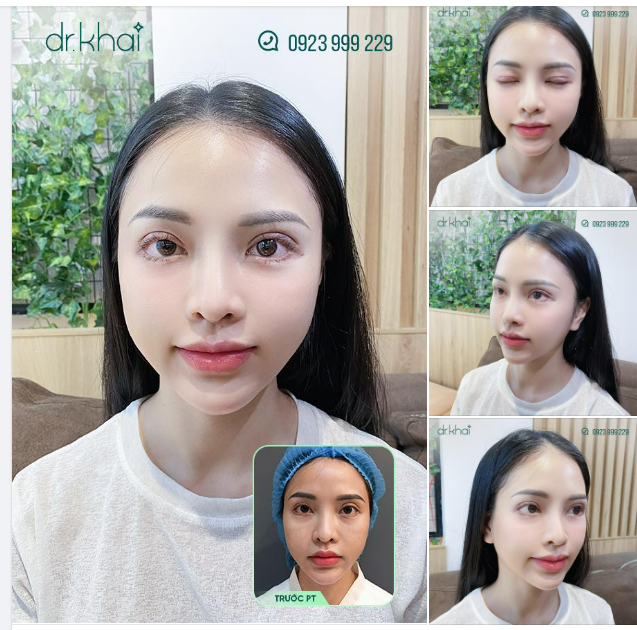 MÍ ĐẸP NGAY LẬP TỨC SAU PHẪU THUẬT