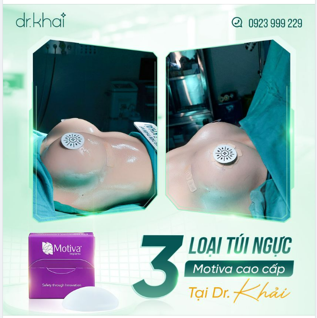3 LOẠI TÚI NGỰC MOTIVA CAO CẤP TẠI DR KHẢI
