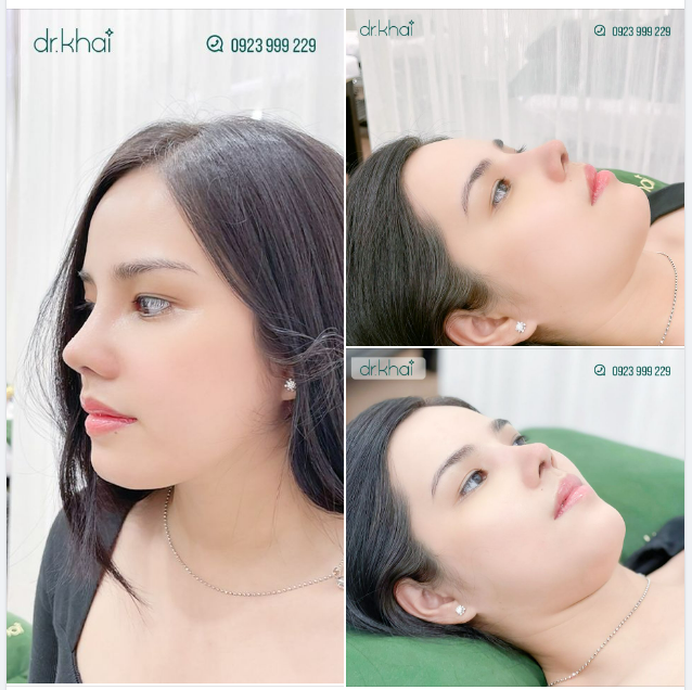 MŨI ĐẸP TẠO GÓC NGHIÊNG THẦN THÁNH