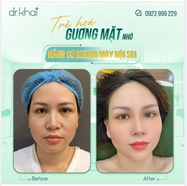TRẺ HÓA GƯƠNG MẶT NHỜ NÂNG CƠ KHUNG CHÂN MÀY NỘI SOI