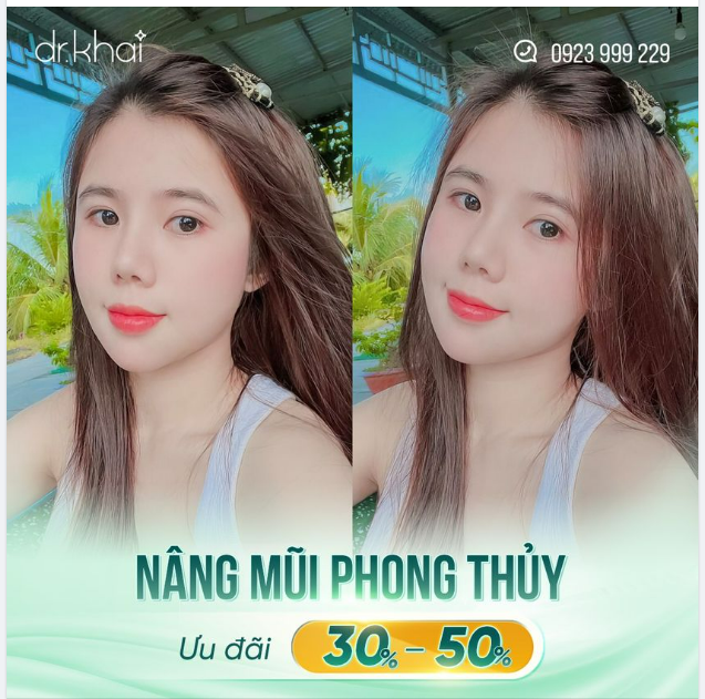 Bạn khách dễ thương gửi hình nâng mũi phong thủy sau 1 tháng.