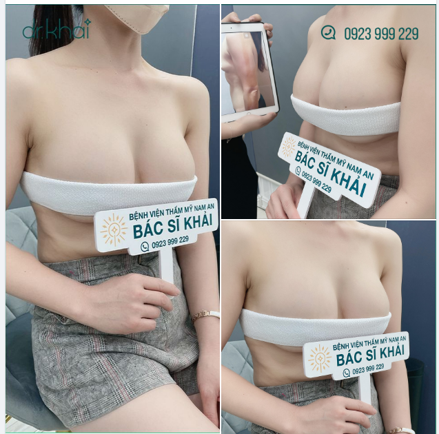 NGỰC NANOCHIP ĐẸP HOÀN HẢO SAU 6 THÁNG