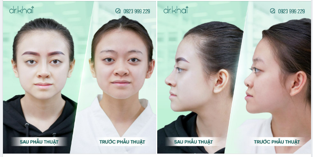 "KHÔNG UỔNG CÔNG TỪ MỸ VỀ VIỆT NAM NÂNG MŨI"