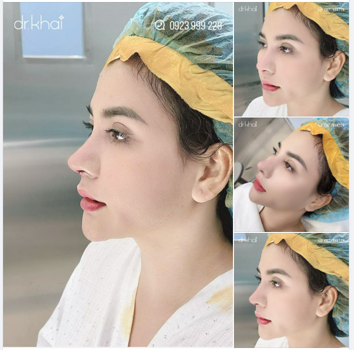 DÁNG MŨI ĐẸP - ĐẦU MŨI CAO SAU HƠN 60 PHÚT NÂNG MŨI TẠI DR KHẢI