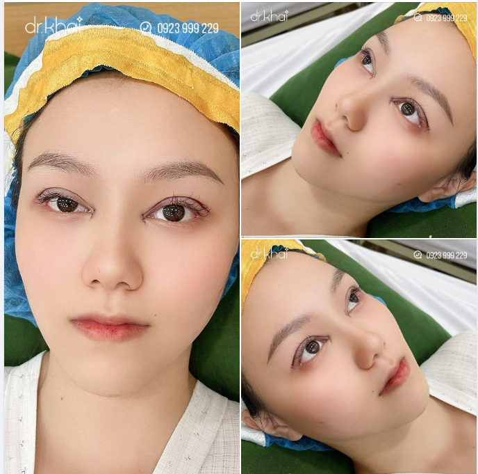 NẾP MÍ ĐẸP - KHÔNG SƯNG - KHÔNG ĐAU NGAY SAU 60 PHÚT