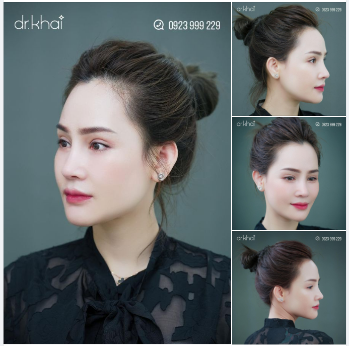 COMBO 200 TRIỆU NÂNG MŨI - CẮT MÍ - CẤY MỠ
