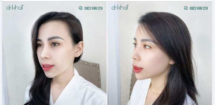 NÂNG MŨI CẤU TRÚC SAU 2 NĂM - KHÁCH XINH NHƯ HOTGIRL