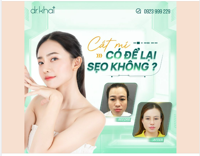 CẮT MÍ CÓ ĐỂ LẠI SẸO KHÔNG?