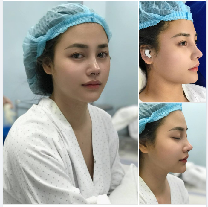 NÂNG MŨI AN TOÀN - ĐẸP NGAY KHI CÒN TRONG PHÒNG PHẪU THUẬT