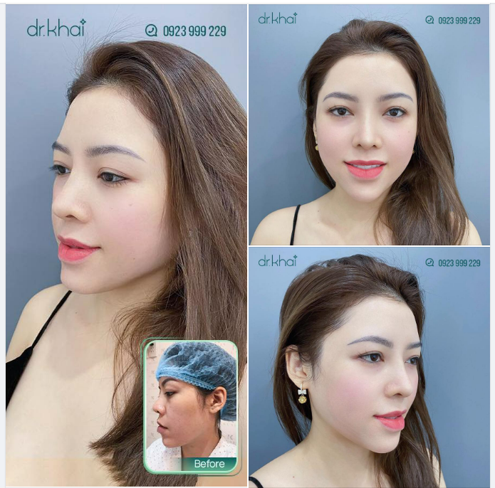MŨI CẤU TRÚC SỬA LẠI 4 NĂM NGÀY CÀNG ĐẸP