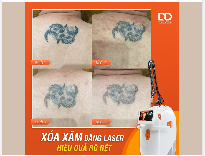 XÓA XĂM BẰNG LASER HIỆU QUẢ RÕ RỆT