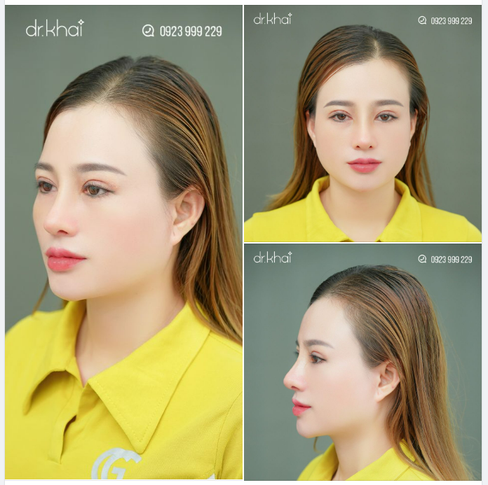 ĐẸP MỌI GÓC CẠNH SAU 9 NGÀY NÂNG MŨI, CẮT MÍ TẠI DR KHẢI