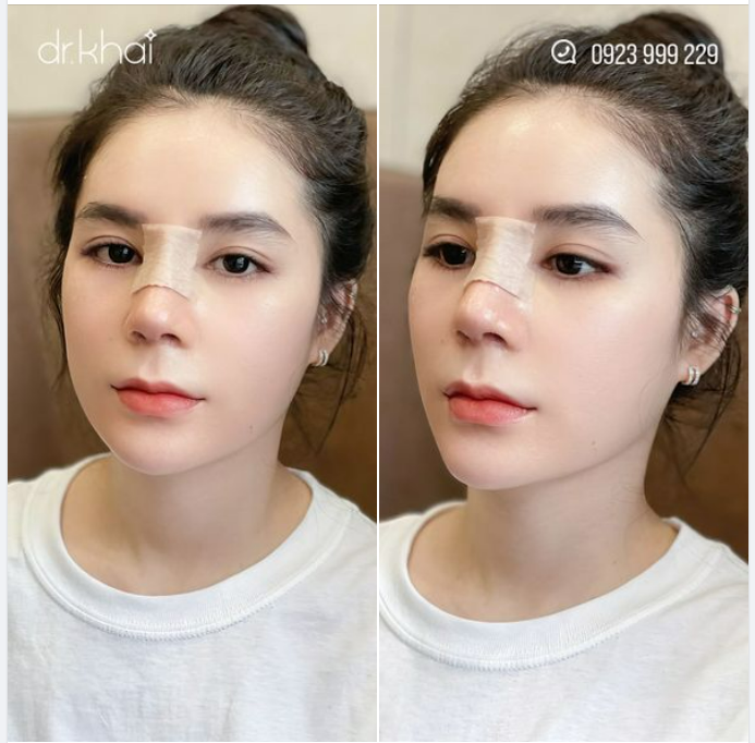 NÂNG MŨI CẤU TRÚC - MỞ GÓC MẮT TRONG