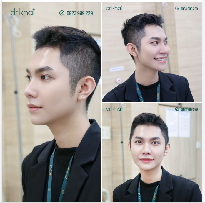 NÂNG MŨI - ĐỘN CẰM ĐẸP CHO NAM GIỚI