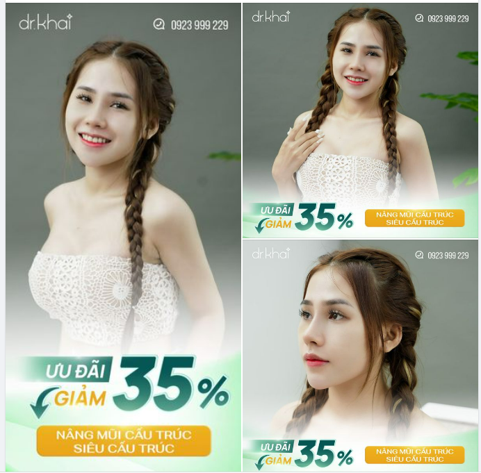 NÂNG MŨI CẤU TRÚC - SIÊU CẤU TRÚC ƯU ĐÃI ĐẾN 35%