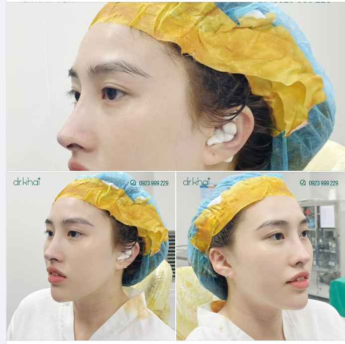 BÁC SĨ KHẢI SỬA MŨI NÂNG BỊ LỘ SỤN SÓNG