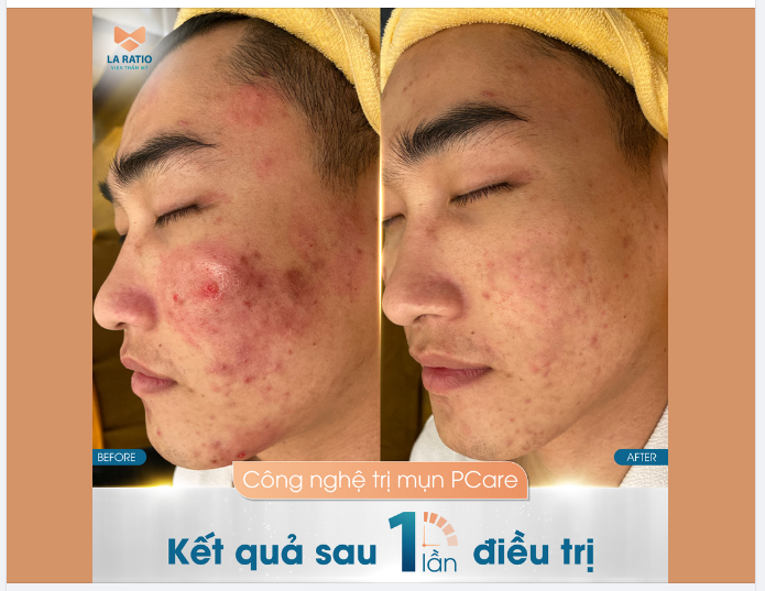 PCARE - CÔNG NGHỆ TRỊ MỤN HIỆN ĐẠI, AN TOÀN