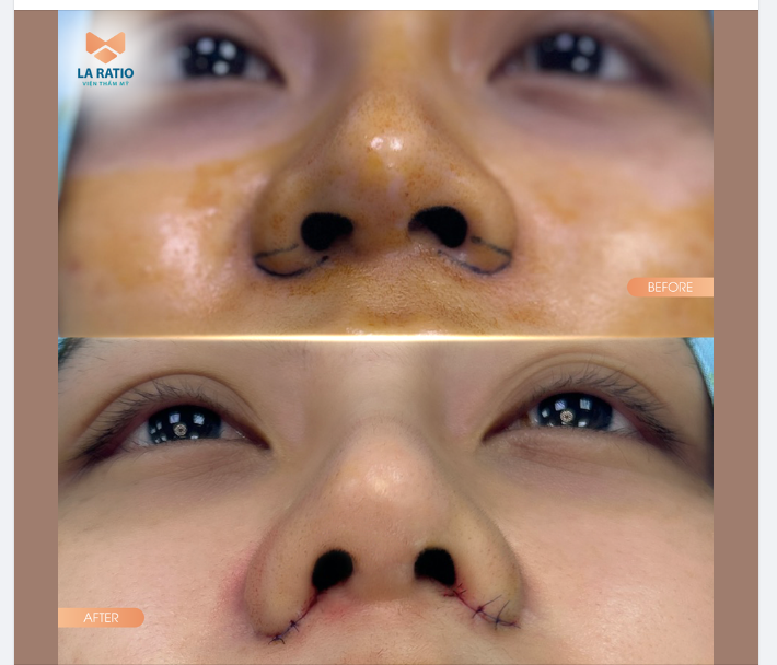 THU GỌN CÁNH MŨI – THON GỌN CHUẨN TỈ LỆ CHỈ SAU 30 PHÚT