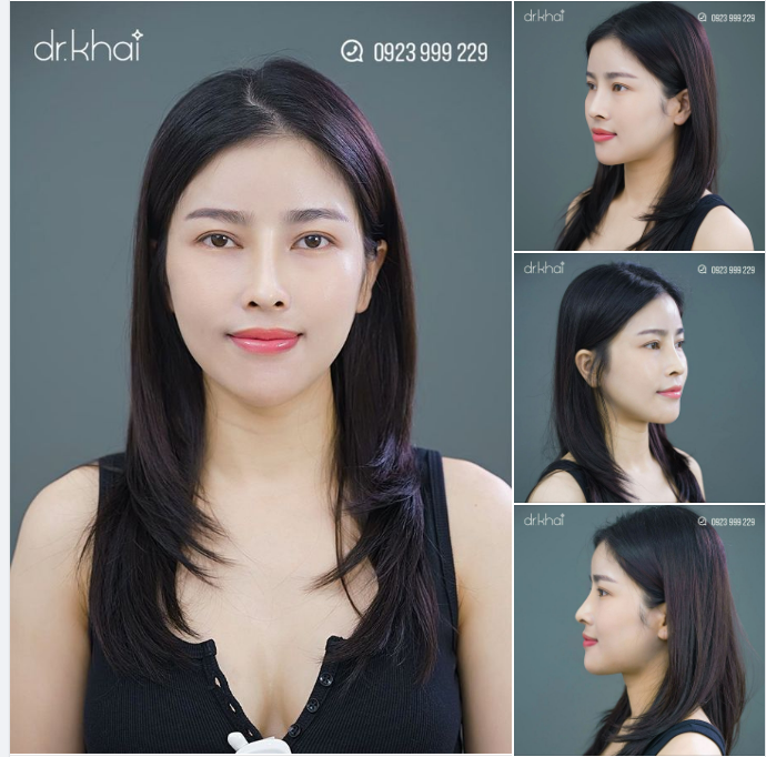 NÂNG MŨI SỤN SƯỜN 200 TRIỆU - MŨI CAO ĐẸP SAU 16 NGÀY