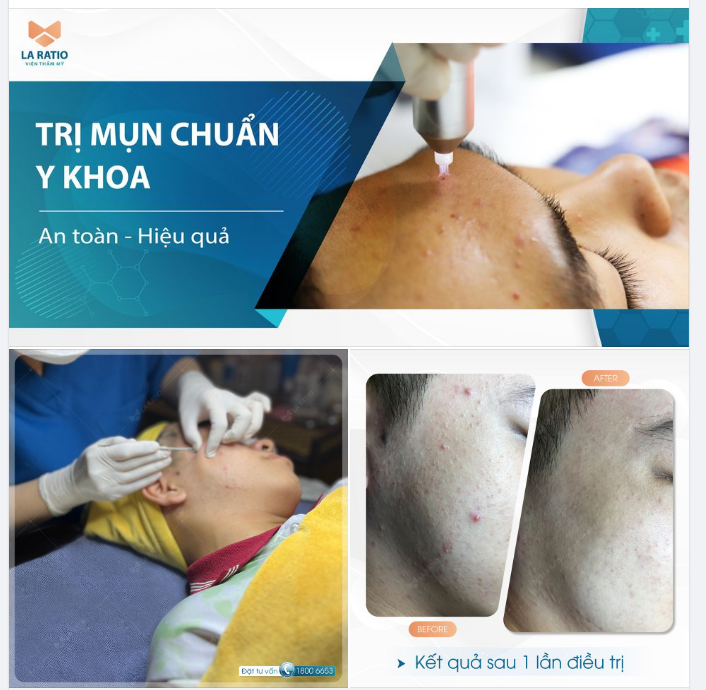Nhiều phụ huynh nghĩ rằng mụn dậy thì sẽ tự hết hoặc con còn nhỏ không nên lấy nhân mụn??