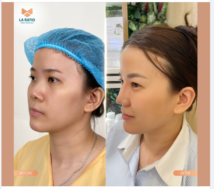 FEEDBACK: Sở hữu nét đẹp tươi trẻ rạng ngời sau 6 tháng nâng mũi tại La Ratio.