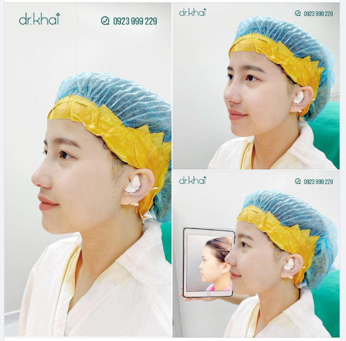 NÂNG MŨI SIÊU CẤU TRÚC KHÔNG ĐAU - ĐẸP NGAY LẬP TỨC
