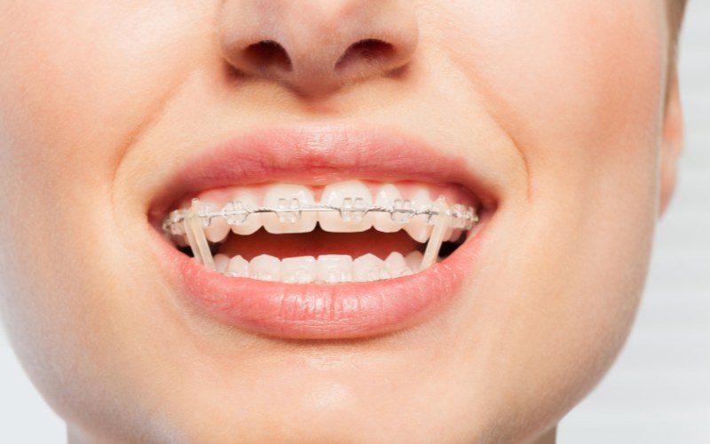 Niềng răng mắc cài sứ truyền thống