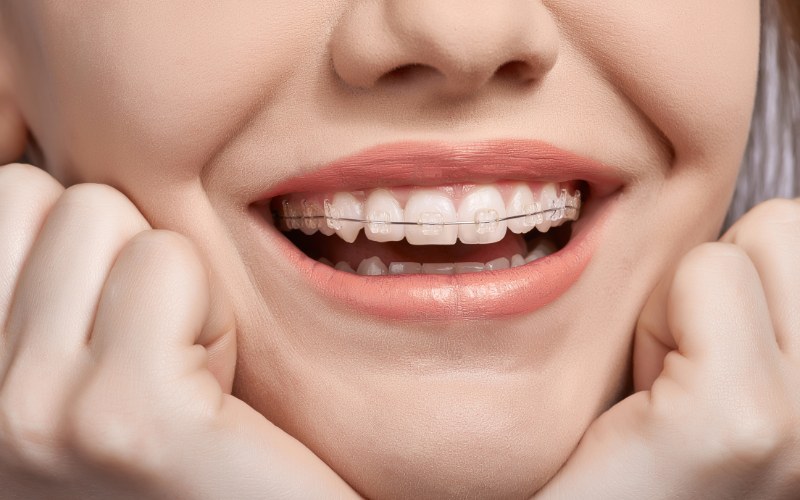 Niềng răng mắc cài sứ tự buộc