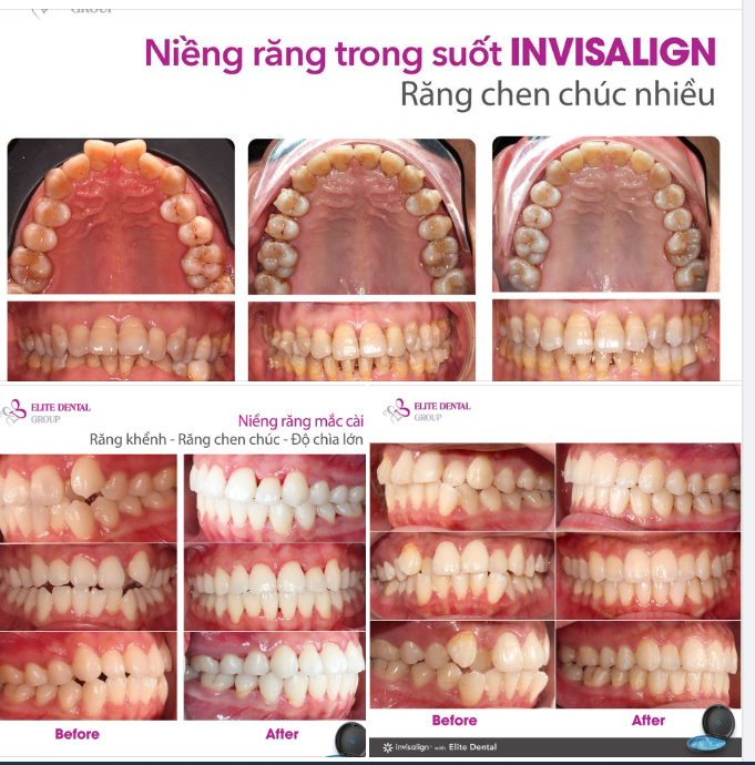 NIỀNG RĂNG CHEN CHÚC CHO NGƯỜI LỚN