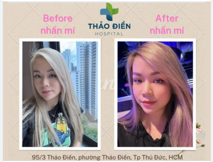 NHẤN MÍ LẤY MỠ - RẠNG RỠ MẮT XINH