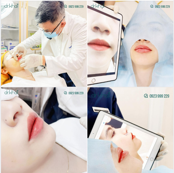 TIÊM FILLER MÔI ĐẦY CĂNG MỌNG - TẠO TỈ LỆ VÀNG CHO KHUÔN MẶT