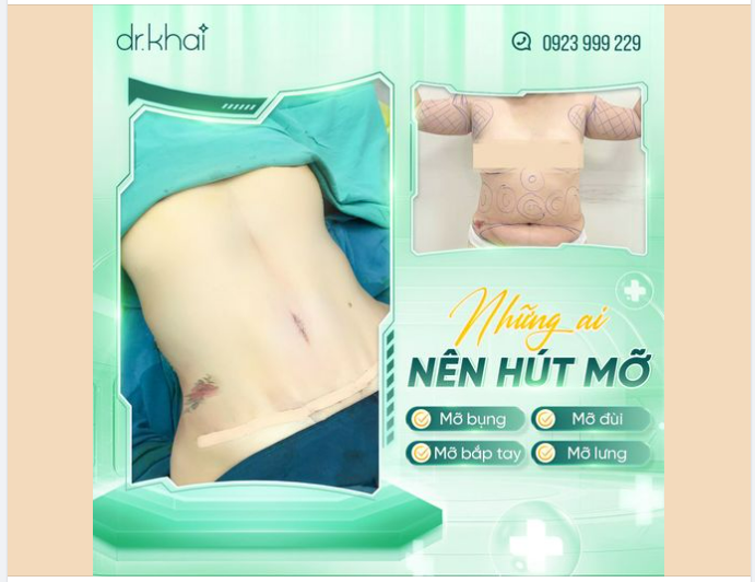 NHỮNG AI NÊN HÚT MỠ ?