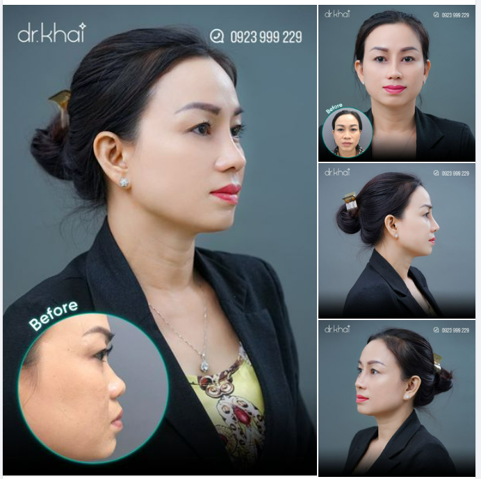 NÂNG MŨI CẤU TRÚC - PHÙ HỢP MỌI ĐỘ TUỔI
