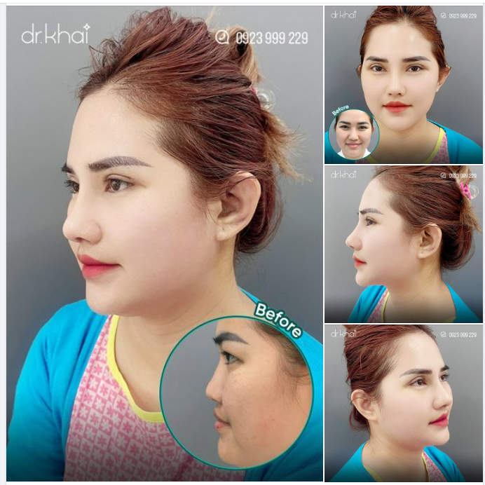 ĐƯỜNG MÍ SẮC NÉT - DÁNG MŨI CAO ĐẸP KHÁCH HÀNG CAMPUCHIA HÀI LÒNG SAU 10 NGÀY PHẪU THUẬT