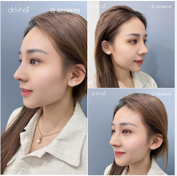 NÂNG MŨI CẤU TRÚC KHÔNG ĐAU - MŨI ĐẸP SAU 10 NGÀY
