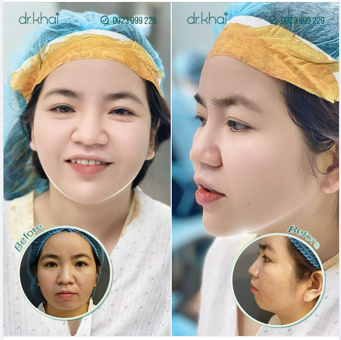 ĐỘN CẰM CHO GƯƠNG MẶT TƯƠI TRẺ - HIỆU QUẢ LÂU DÀI
