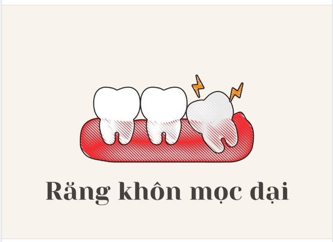 LƯU Ý SAU KHI NHỔ RĂNG KHÔN.