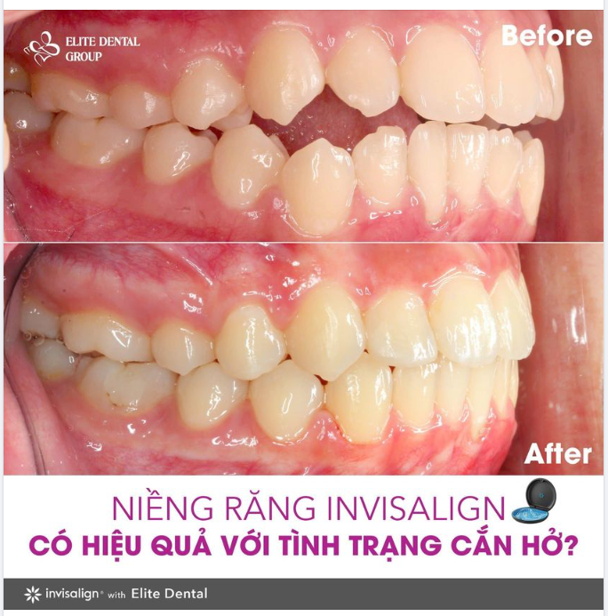KHI NIỀNG RĂNG TRONG SUỐT ĐIỀU TRỊ CẮN HỞ