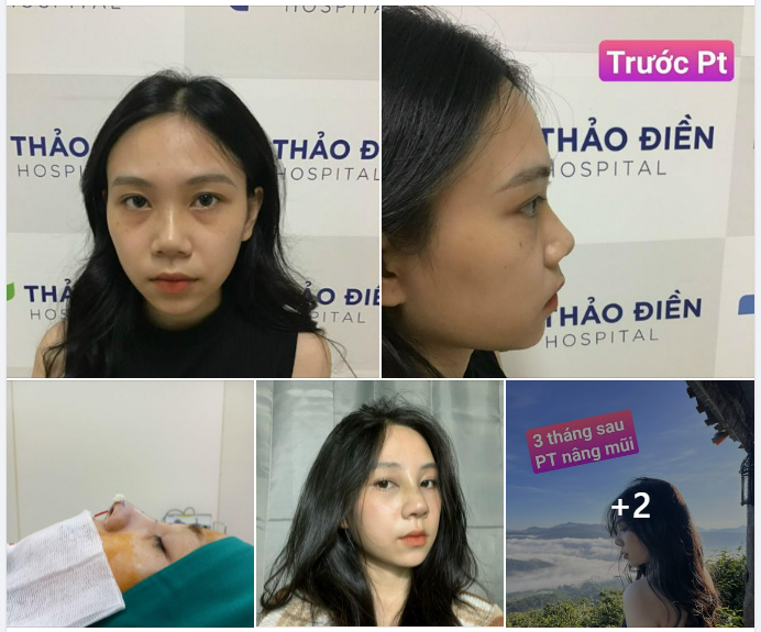 Nâng mũi tự nhiên cùng Dr.Thắng