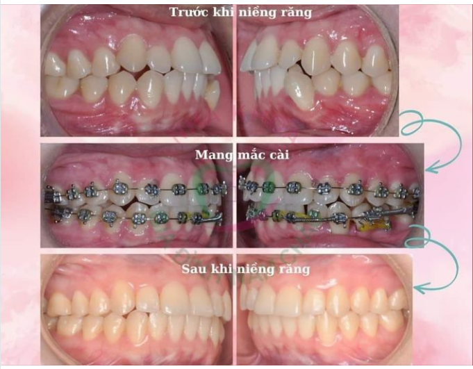 TIỀN CHỈNH NHA - TIẾT KIỆM TỐI ĐA THỜI GIAN VÀ CHI PHÍ